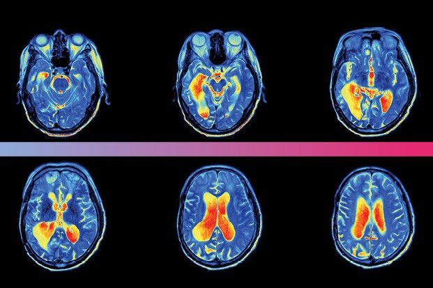 A tomografia não é capaz de diagnosticar a depressão de um indivíduo. Mas a reunião de 100 exames de pessoas saudáveis, comparada à reunião de 100 outros de pessoas deprimidas, mostra uma clara diferença na atividade cerebral.  (Foto: Getty Images)