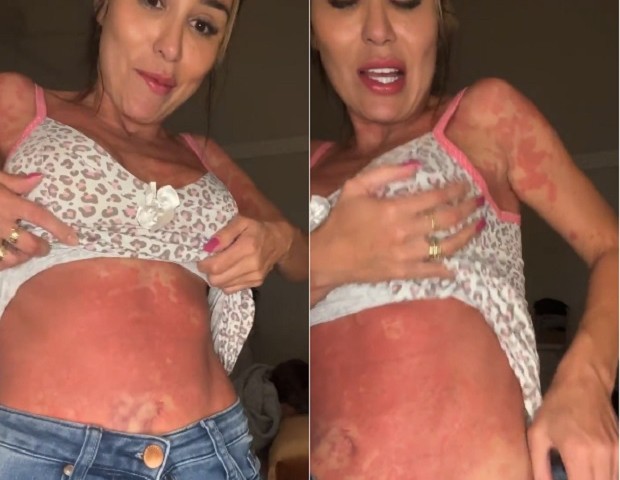 31 de maio de 2022: Letícia Santiago mostra manchas pelo corpo (Foto: Reprodução/Instagram)