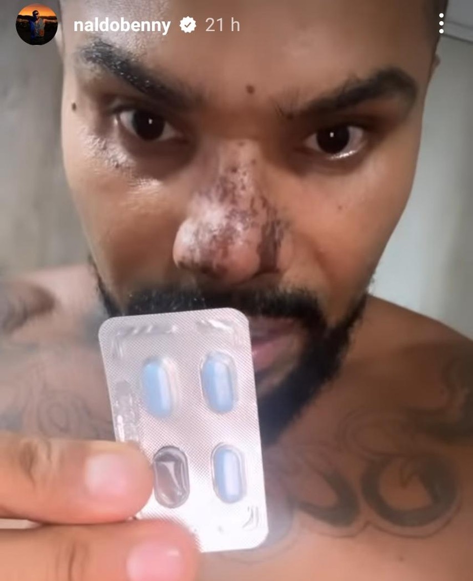 Naldo Benny está tomando Viagra para tratar necrose no nariz
