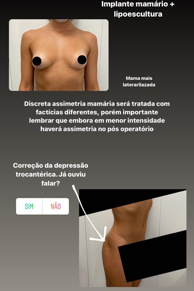 Gabi Martins faz lipoescultura e coloca silicone nas mamas (Foto: Reprodução/Instagram)
