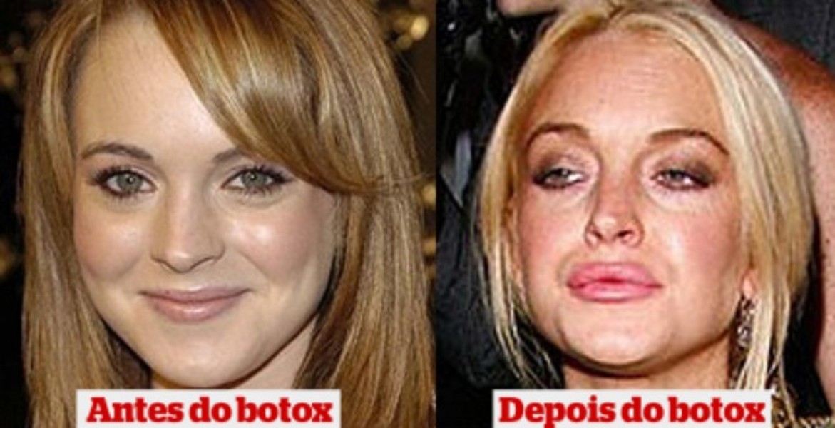 Quiz: Antes e Depois do Botox | Jogos | Download | TechTudo