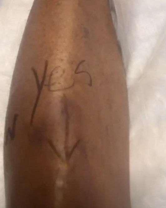 O rapper Diddy mostrou a perna dele que passou por uma cirurgia (Foto: Instagram)