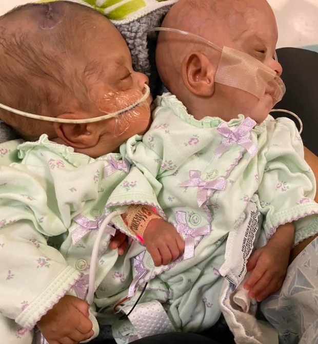 Gêmeas nascem de 22 semanas e surpreendem médicos (Foto: Reprodução: Tracey Hernandez/Metro.co.uk)