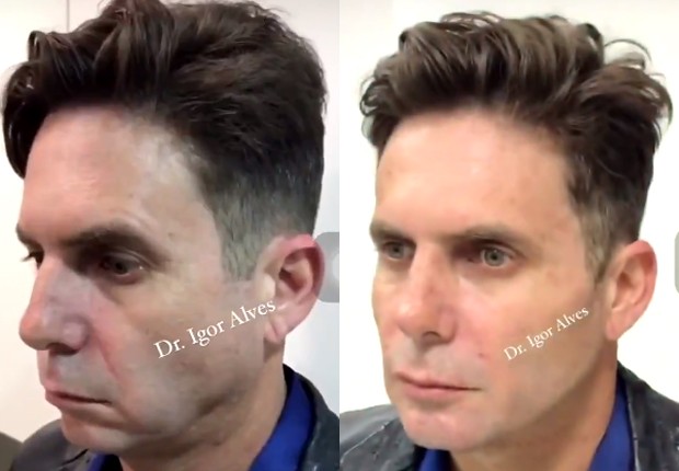 Antes e depois de Hudson Cadorini ap´pos harmonização facial (Foto: Reprodução/Twitter)