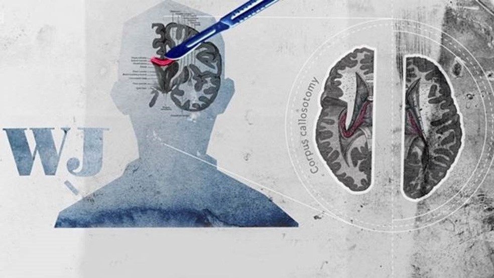 Casos graves de epilepsia, como o do paciente WJ, eram tratados dividindo-se o cérebro em duas metades — Foto: PIERANGELO PIRAK/BBC REEL