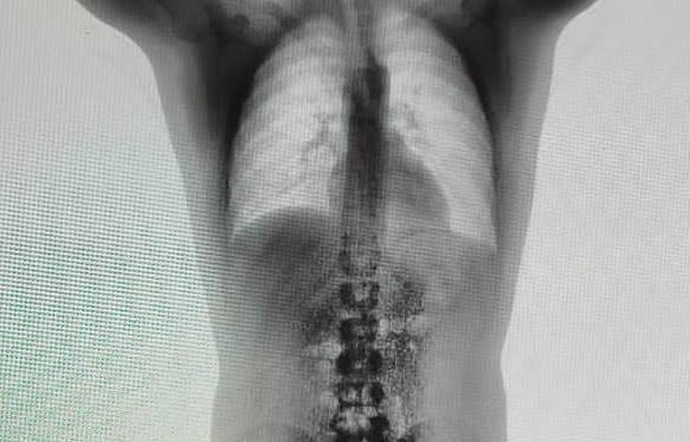 Drogas foram encontradas durante escner corporal — Foto: Reproduo/Interligado Muria