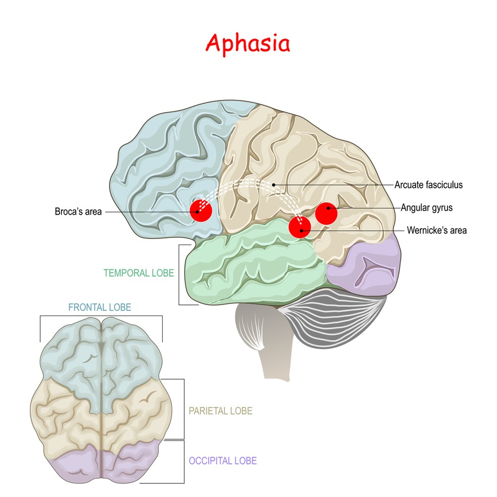 A afasia atinge o lado esquerdo do cérebro, área que centraliza a linguagem — Foto: Istock Getty Images