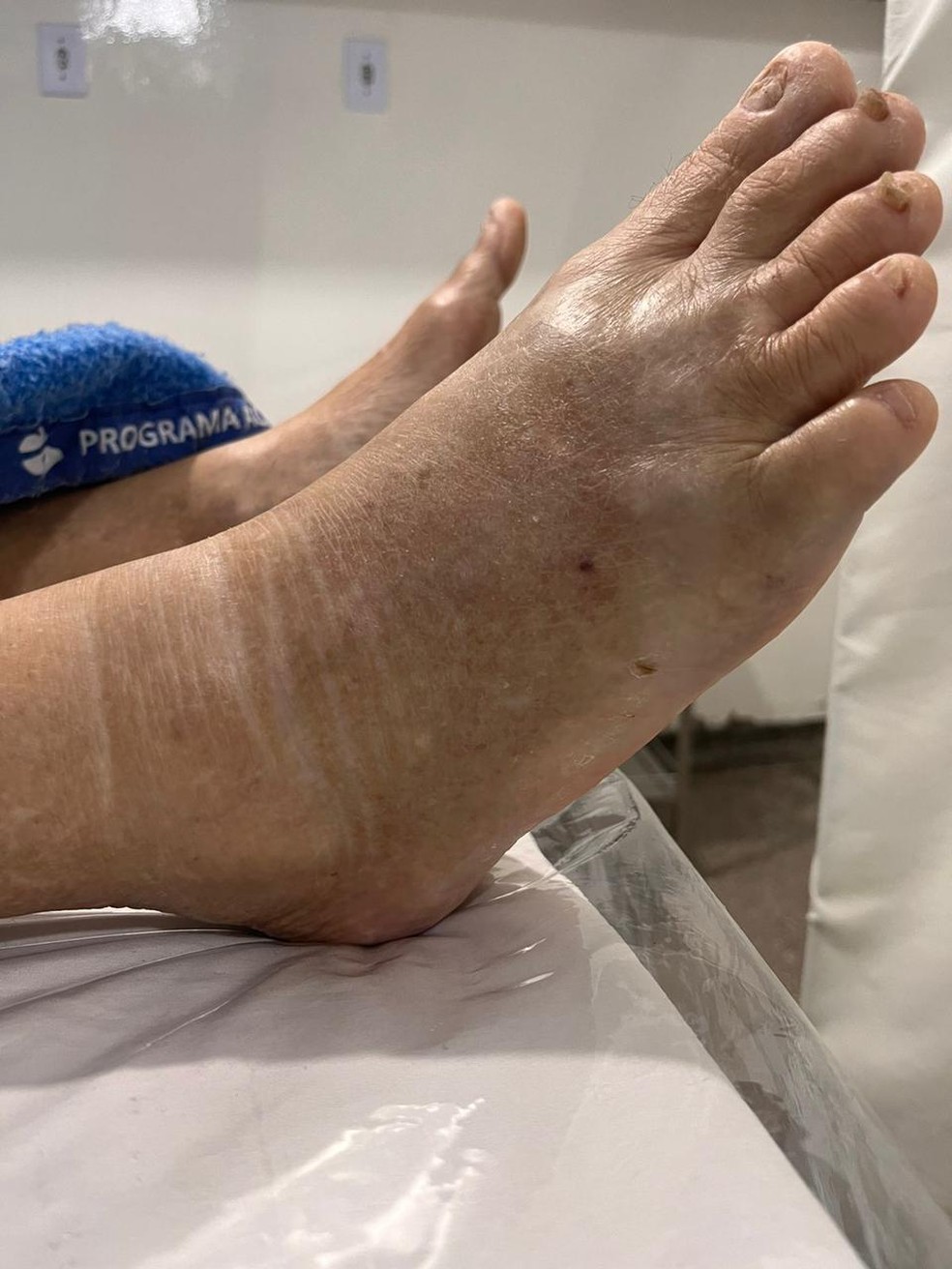 Vítima teve muito inchaço no pé, após a picada — Foto: Reprodução