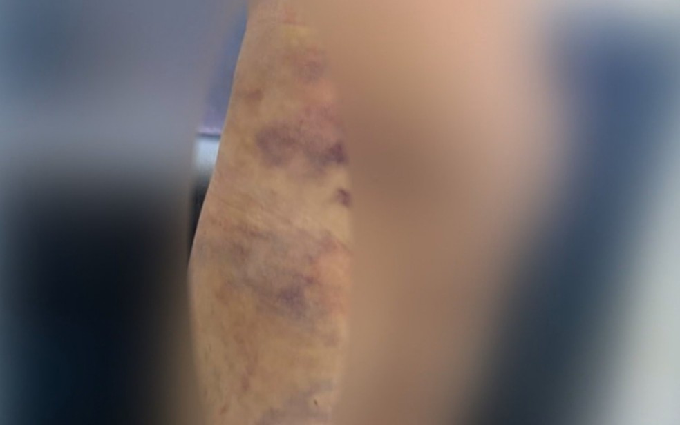 Criança de 6 anos fica com hematomas pelo corpo após ser agredida; mãe e companheira são suspeitas — Foto: Reprodução/TV Anhanguera