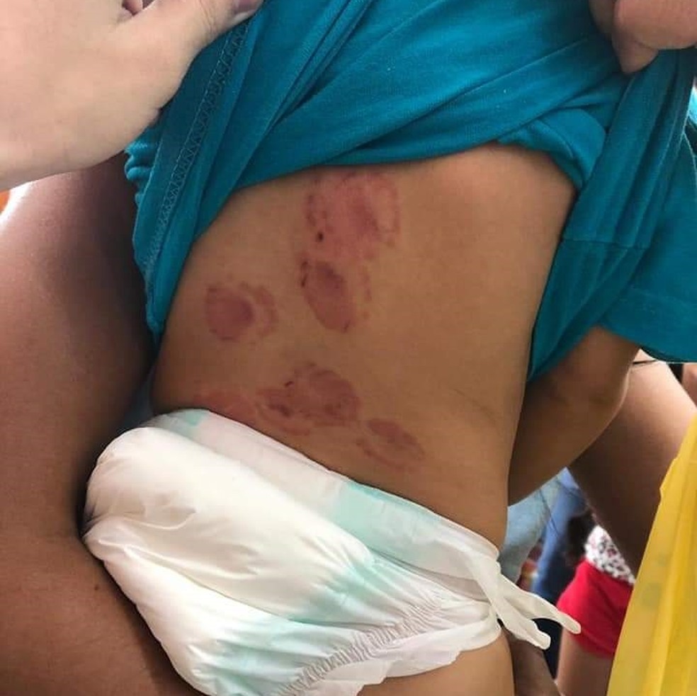 Mãe registra ocorrência após bebê de 1 ano ser entregue pela creche com marcas de mordida