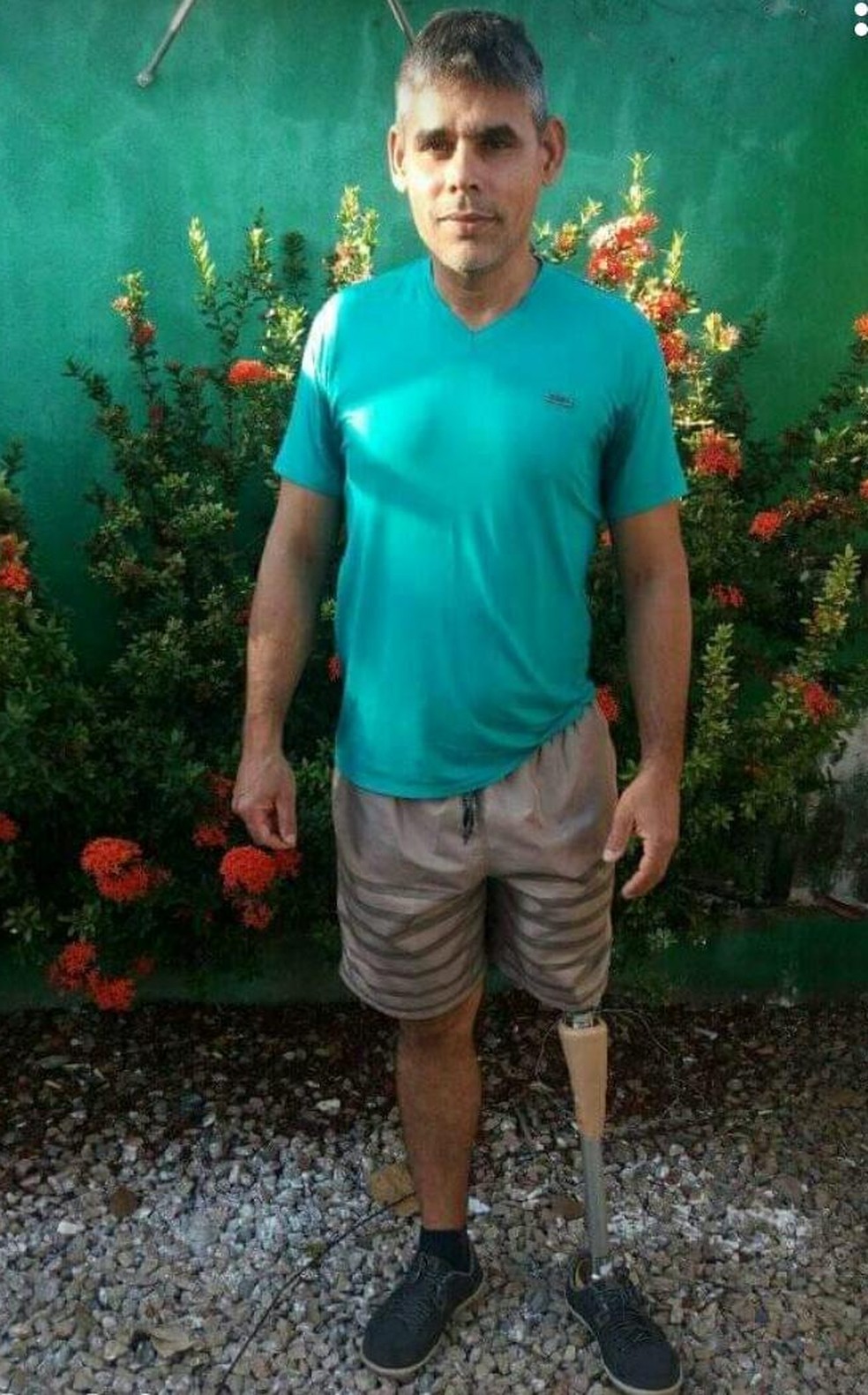 Darliney Silva Madaleno vai passar por cirurgia para usar prótese — Foto: Arquivo pessoal