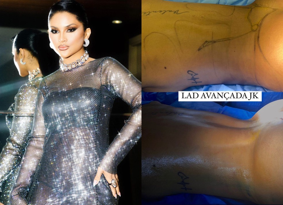 Mileide Mihaile mostra antes e depois de lipo LAD — Foto: Reprodução/Instagram