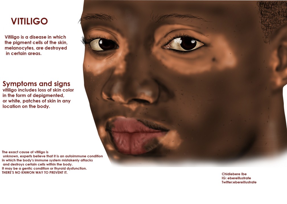 Ilustração médica do nigeriano Chidiebere Ibe mostra vitiligo em pele negra. — Foto: Reprodução/Chidiebere Ibe