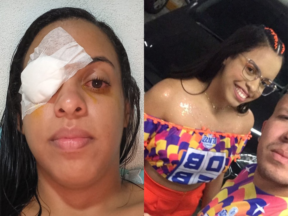 A dona de casa Mayara Santana precisou usar tampão no olho após sofrer queimadura na retina após pomada capilar cair nos olhos — Foto: Mayara Santana/Arquivo pessoal