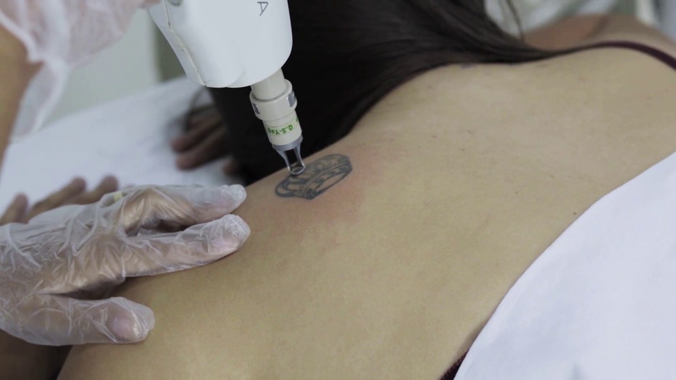 Imagem de procedimento para remoo de tatuagem  Foto: OligoFlora/Divulgao