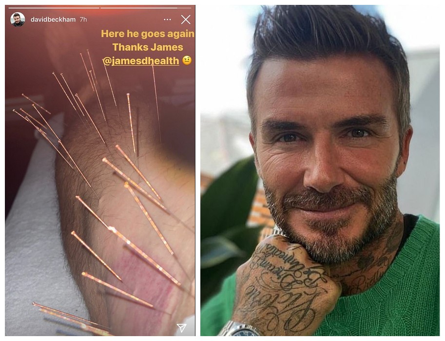 O ex-jogaor de futebol David Beckham compartilhou uma foto que mostra uma de suas pernas durante uma sessão de acupuntura (Foto: Instagram)