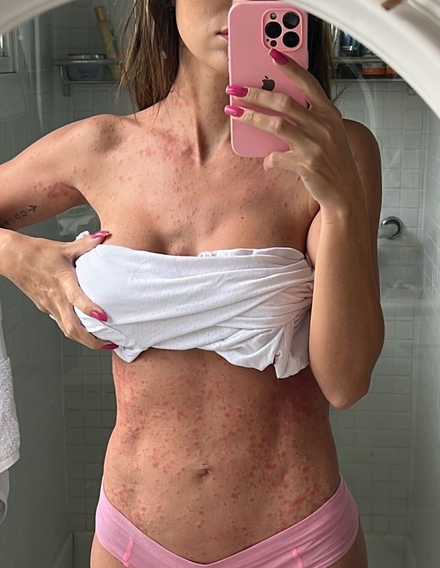 30 de maio de 2022: Leticia Santiago mostra inflamação no corpo (Foto: Reprodução/Instagram)