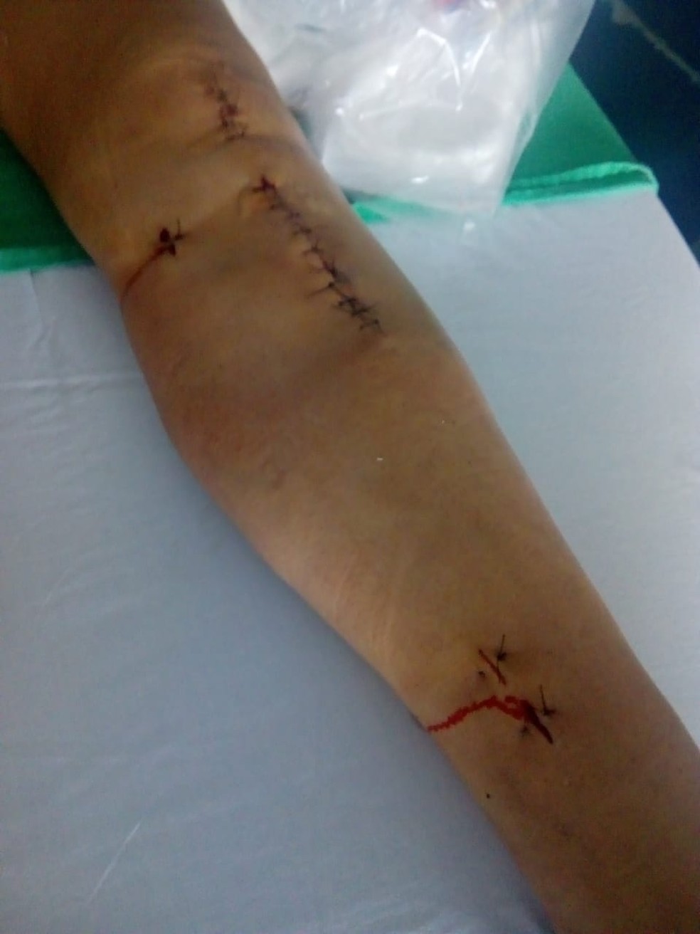 Imagem mostra os pontos e machucados na perna esquerda de Silvana após cirurgia — Foto: Silvana de Souza/Arquivo pessoal