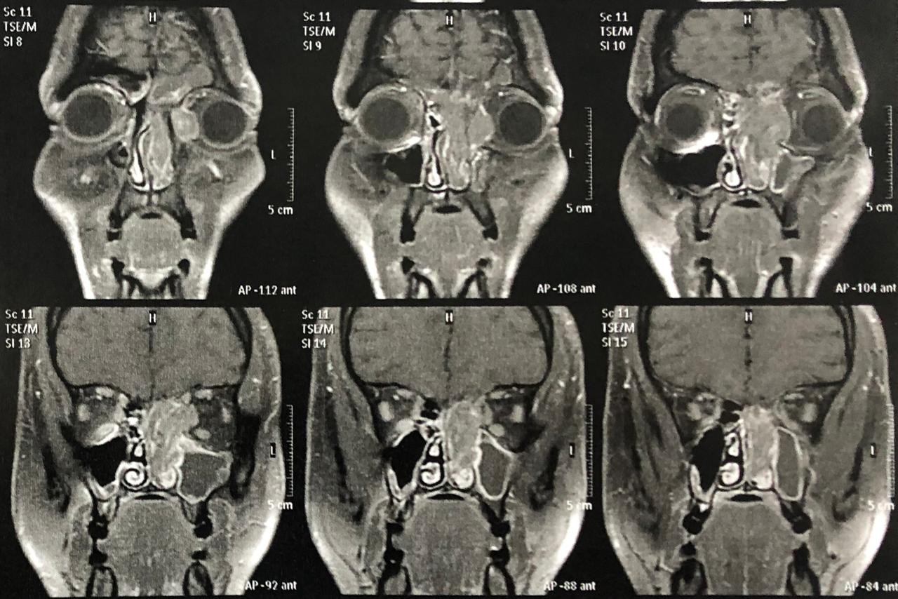 Raio-X mostra o tumor cerebral do tipo estesioneuroblastoma (Foto: HUC)