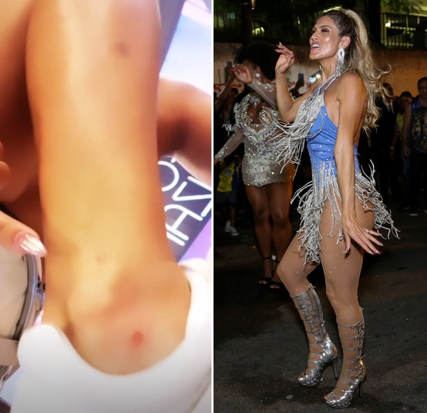 Lívia Andrade mostra hematomas e cicatrizes na perna após noite de samba (Foto: Reprodução/Instagram e Roberto Filho/Brazil News)