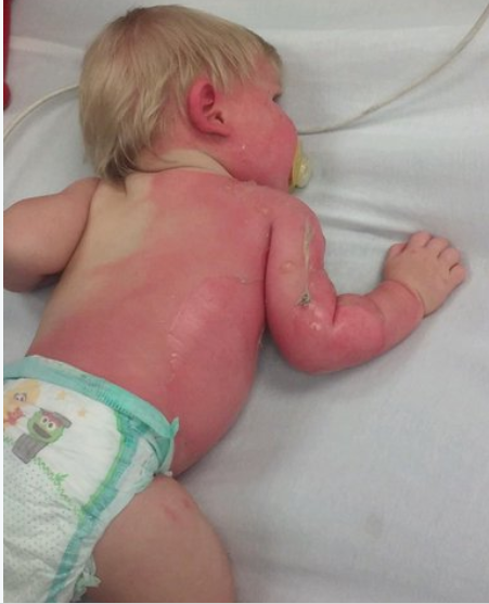 Bebê de 9 meses queimada devido ao esguicho acidental de mangueira deixada no sol (Foto: Reprodução Twitter)