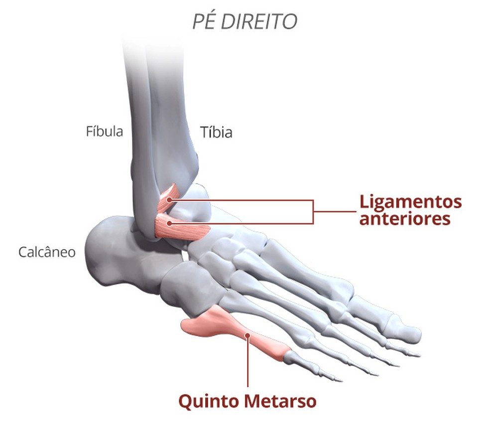Veja detalhes do local da lesão e da fissura do pé direito de Neymar (Foto: infoesporte)