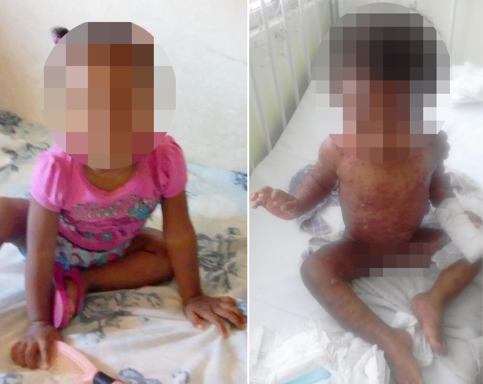 Camily antes e durante o aparecimento de bolhas ainda em casa, em Bertioga, SP (Foto: Arquivo Pessoal)