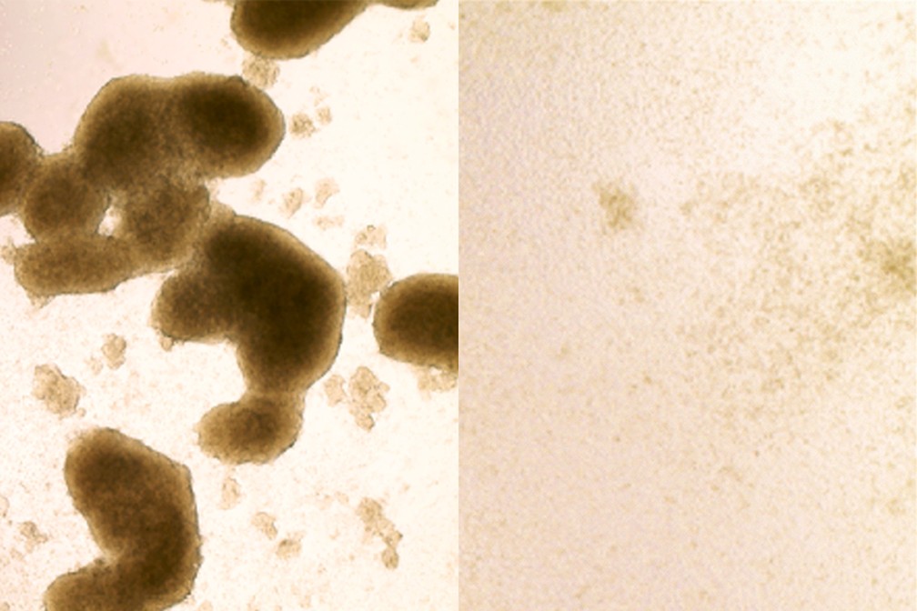 Células-tronco do câncer cerebral (à esquerda) são mortas pela infecção do vírus Zika. A imagem à direita mostra células após o tratamento com Zika. (Foto: Zhe Zhu)