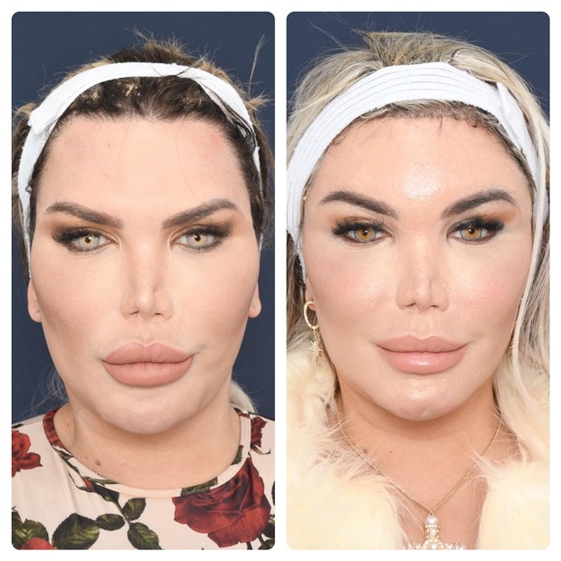 Roddy Alves mostra o antes e depois de sua cirurgia de feminização facial (Foto: Arquivo pessoal)