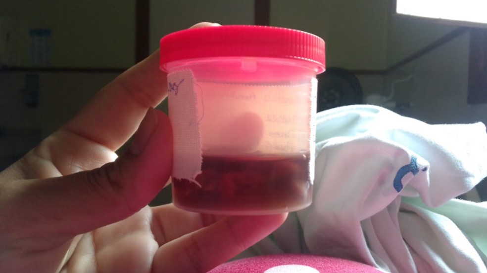 Regina Amélia retirou as trompas de falópio na última quarta-feira (23) — Foto: Arquivo pessoal