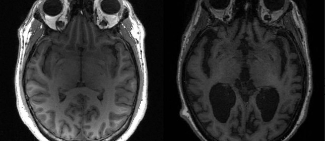Imagem mostra cérebro saudável à esquerda e cérebro com Alzheimer à direita.