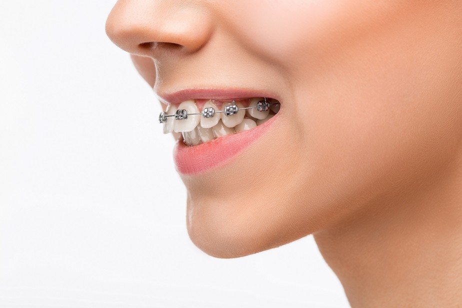 Uso De Aparelho Dental Deve Respeitar Todo O Tratamento Para Que O Resultado Seja Adequado Saude Bucal Em Foco G1