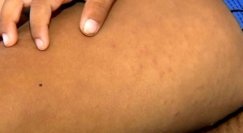 Criancas Contraem Sindrome Mao Pe Boca E Sao Afastadas De Escola Em Sorocaba Sorocaba E Jundiai G1