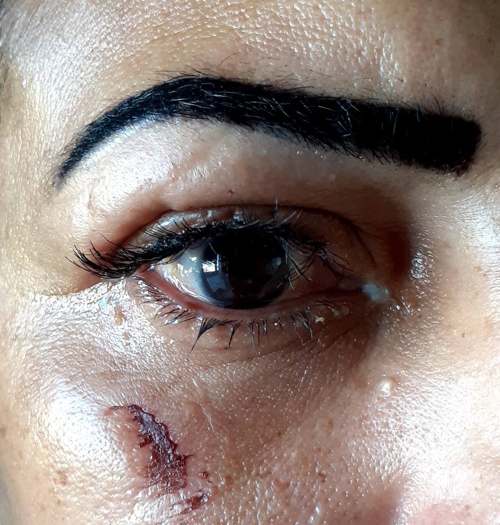 Mulher sofre lesões nos olhos depois de colocar cílios postiços em clínica de estética em Porto Velho — Foto: Facebook/Divulgação