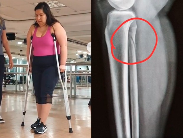 Mariana Xavier sofreu um acidente em janeiro e precisou fazer uma cirurgia de emergência (Foto: Reprodução/Instagram)
