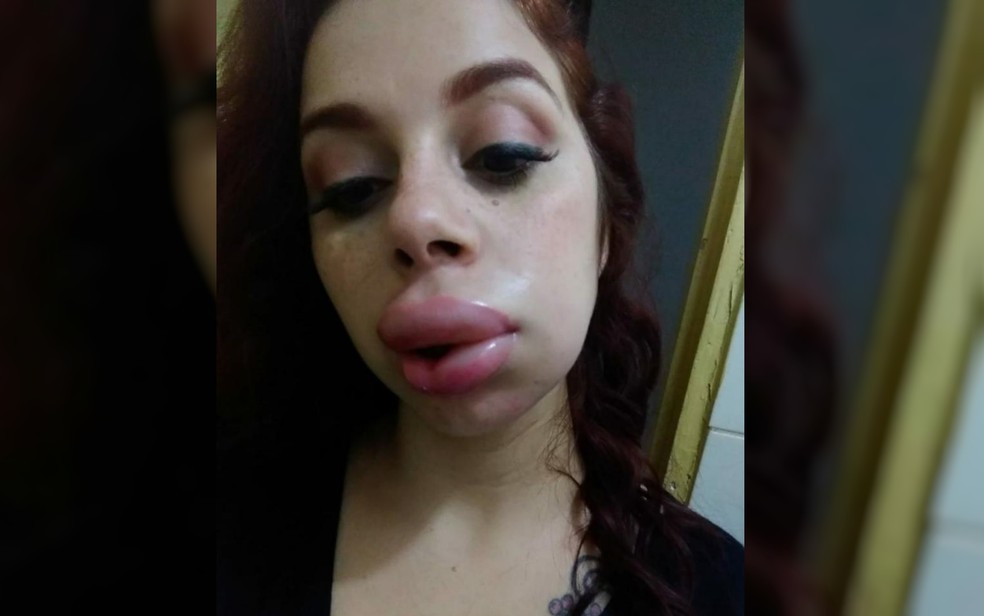 Hanna quando estava com rosto inchado por causa da Urticária — Foto: Arquivo Pessoal/Kárita Hanna