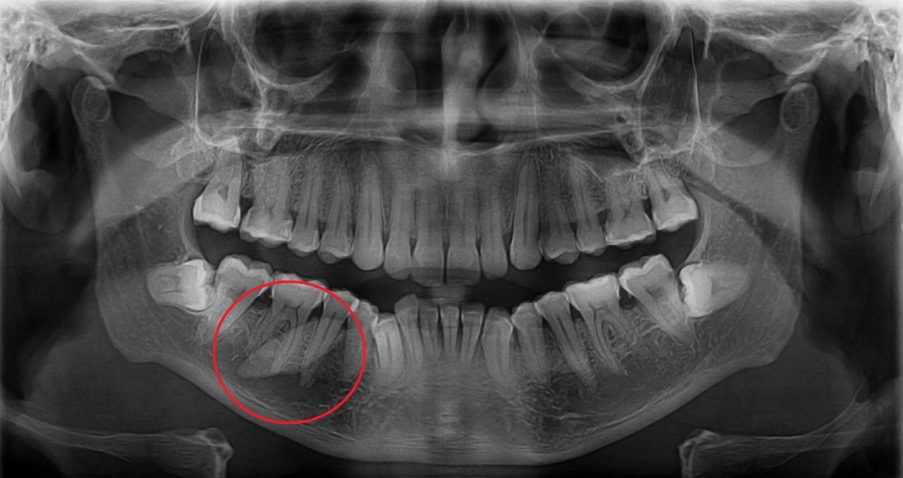 Médicos retiram pedra de saliva de 2 cm da mandíbula de paciente (Foto: Nilesh et al., BMJ, 2020)