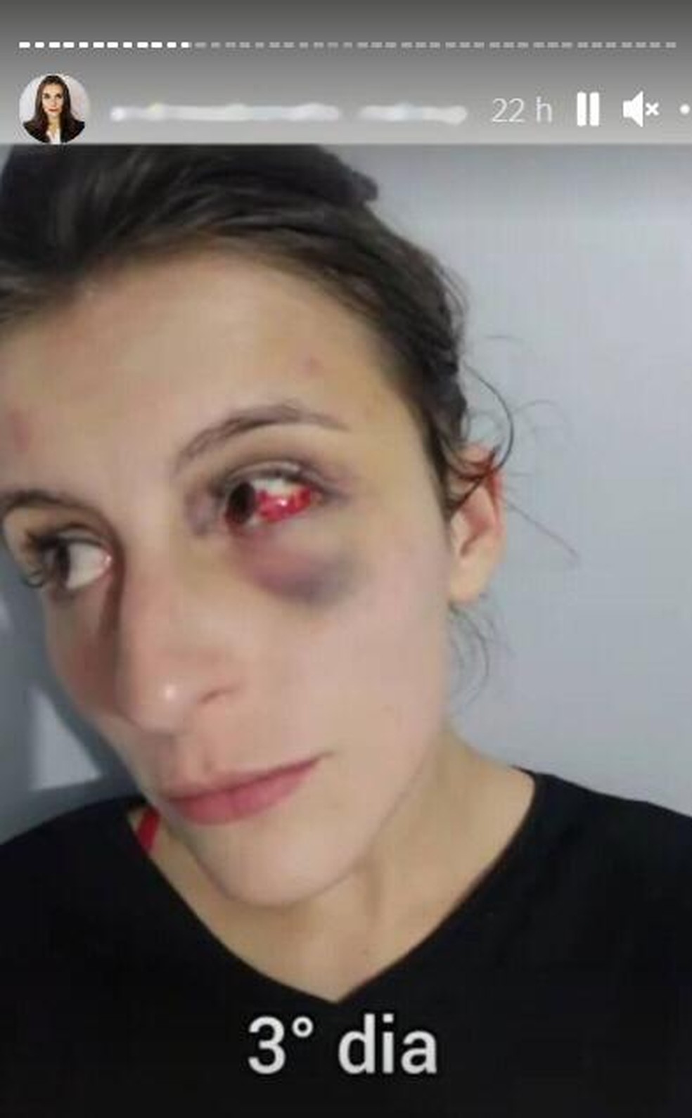 Andressa publicou uma foto do seu rosto dias após a agressão  — Foto: Redes Sociais/Reprodução