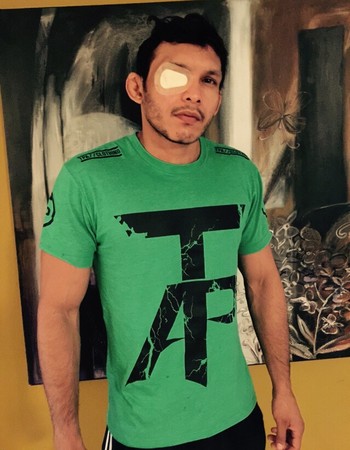 Luis Sapo com olho machucado (Foto: Arquivo Pessoal)