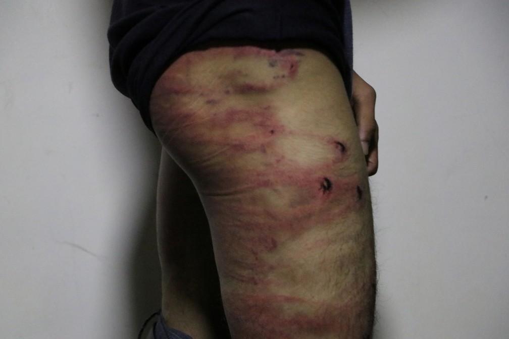 Jornalista mostra ferimentos após ser espancado pelo Talibã em Cabul, Afeganistão. Foto tirada em 8 de setembro de 2021 — Foto: Etilaatroz/via Reuters