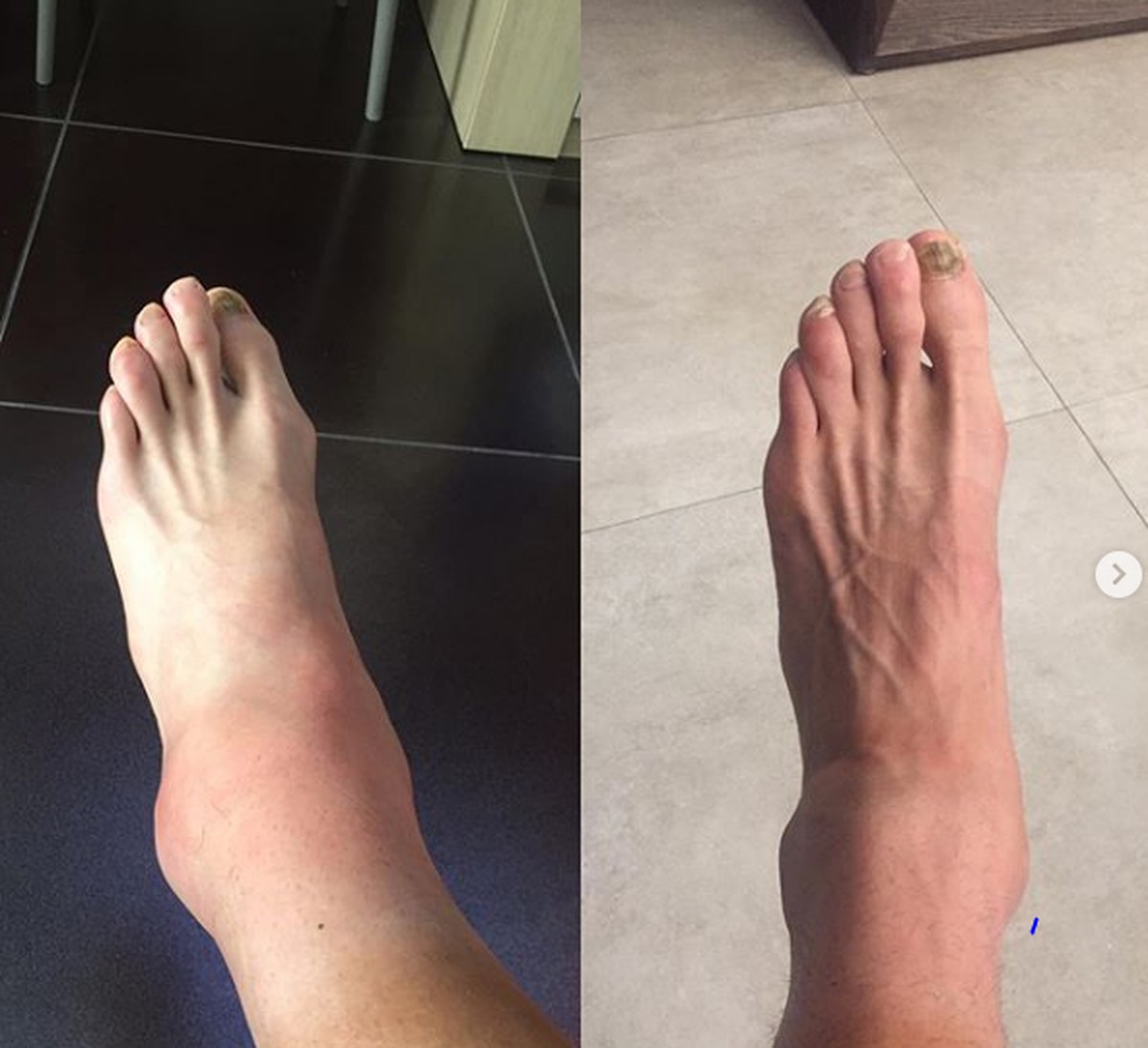Bellucci não se recupera a tempo de torção no tornozelo e desiste do