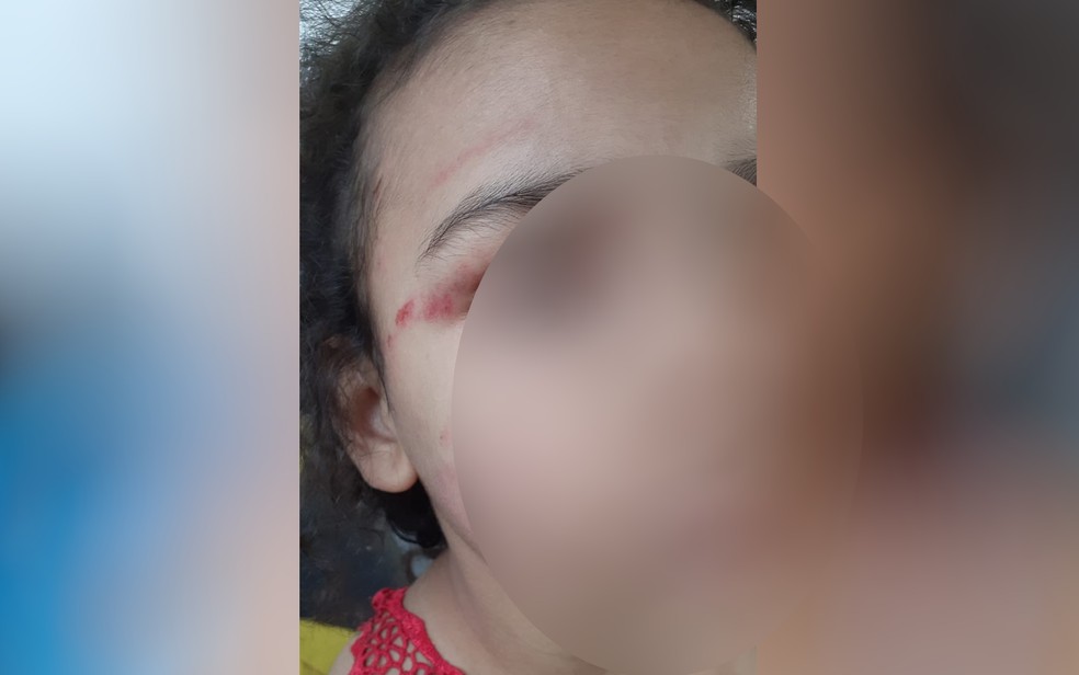 Menina de 6 anos ficou com várias lesões no rosto após ser agredida pelo namorado da mãe, em Goiânia — Foto: Reprodução/Conselho Tutelar