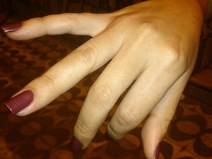 Professora agredida diz que não consegue mexer os dedos (Foto: LG Rodrigues / G1)