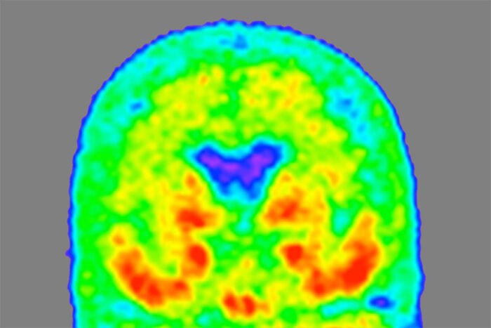 Descoberta nova forma de proteína associada ao Alzheimer. Acima:Mapa térmico do cérebro de uma pessoa com Alzheimer leve. Regiões vermelhas e laranjas indicam maior densidade de proteína tau, enquanto áreas verdes e azuis indicam menor acúmulo. (Foto: TAMMIE BENZINGER/KNIGHT ADRC)