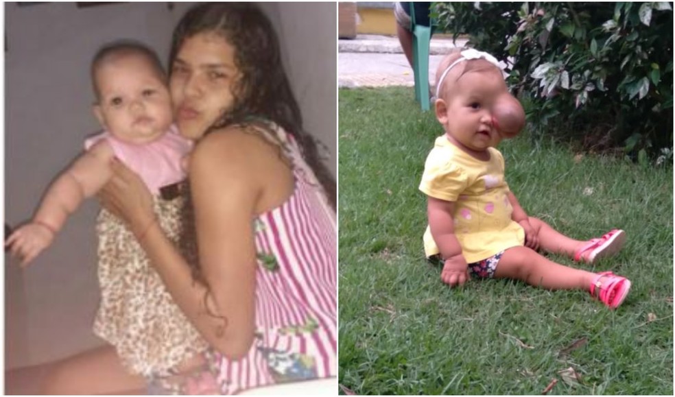 À esquerda Maria Hena e a mãe Marcela antes do crescimento do tumor. À direita Maria Helena com o tumor já avançado.  — Foto: Arquivo pessoal