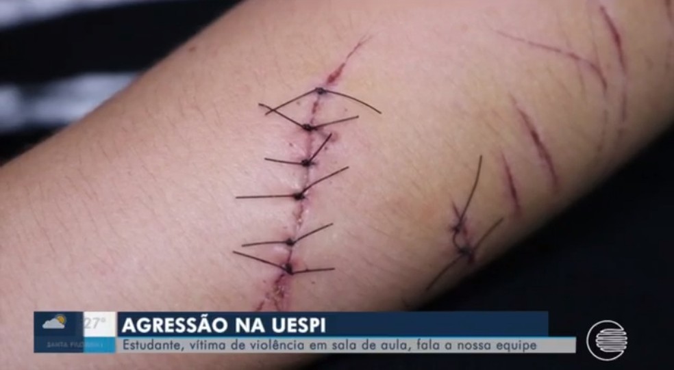 Estudante relatou agressão sofrida na Uespi de Parnaíba — Foto: Reprodução/TV Clube