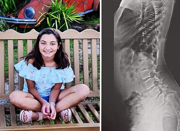 Condição de Marcela, 12, é degenerativa. Por isso, a cirurgia deve ser realizada com urgência (Foto: Reprodução/Instagram)