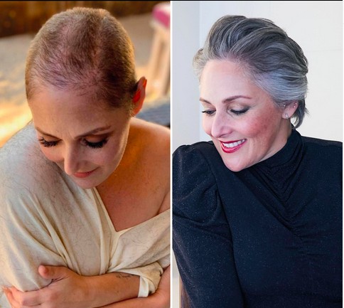 A montagem compartilhada pela atriz Ricki Lake para mostrar o resultado de seu tratamento contra alopecia (Foto: Instagram)