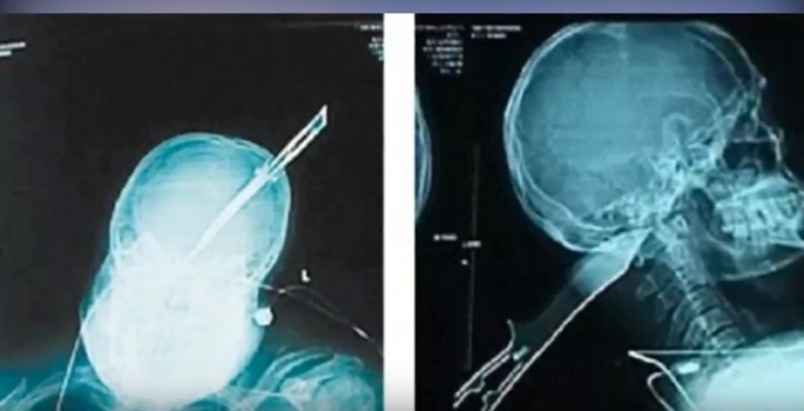 Imagem de raios-x exibe a extensão do ferimento no crânio do homem (Foto: Reprodução/YouTube)