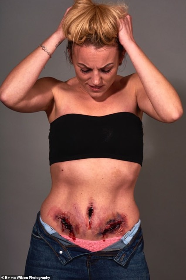 A modelo também sofre com a endometriose (Foto: Reprodução Instagram)